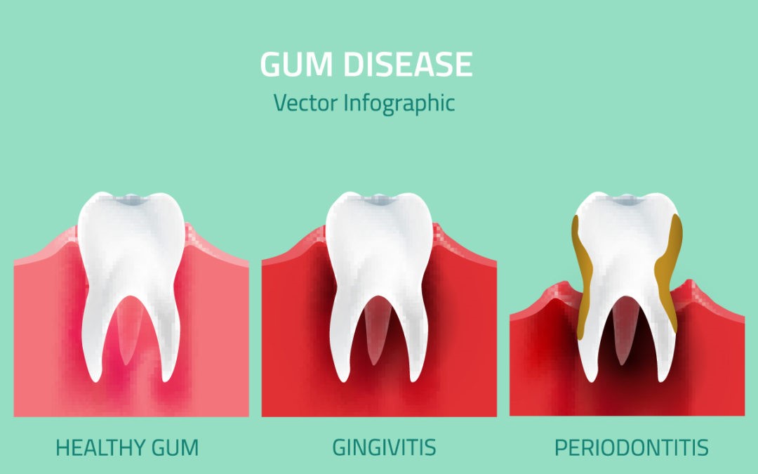 Gum disease treatment may be nonsurgical or surgical, depending on the stage of disease and your oral and overall health. Nonsurgical treatments include.
