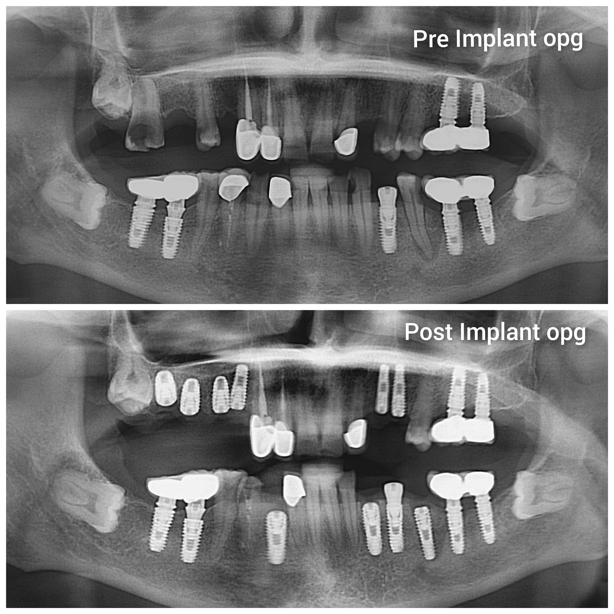 Pre & Post Implant