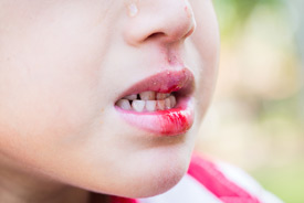 Children Front Tooth Trauma