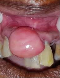 Oral Cyst s